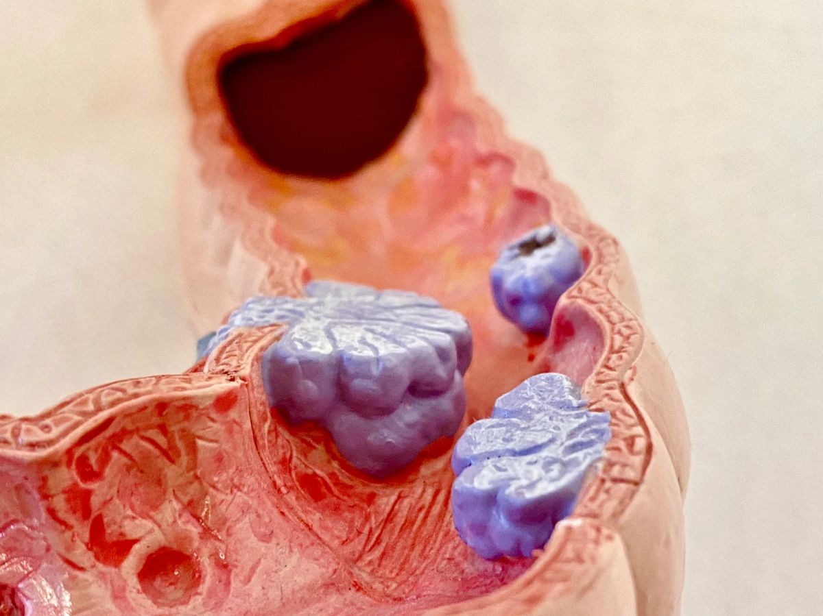 Anatomski model raka debelog crijeva