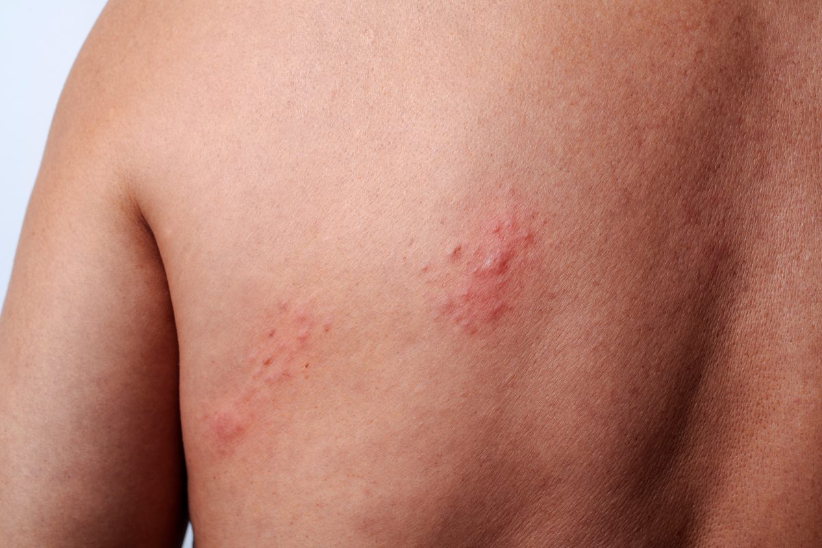 Herpes zoster